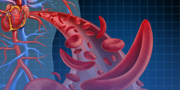 SUS vai disponibilizar dois novos medicamentos para a doença falciforme