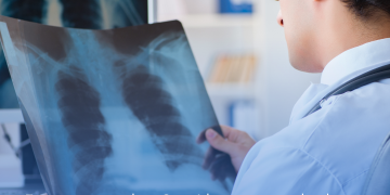 Em reunião da Cosaúde, são analisadas tecnologias para o tratamento de câncer de pulmão, linfoma, leucemia mieloide crônica, além da proposta de atualização das diretrizes de utilização para o tratamento de asma grave