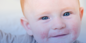Dermatite atópica: terapia avançada será incorporada no SUS para crianças