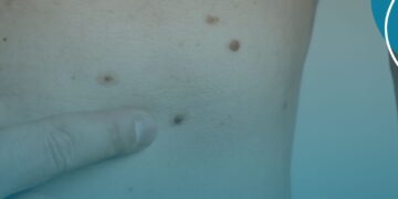 Tecnologia de implante auditivo para perda auditiva é tema de consulta pública da Comissão Nacional de Incorporação de Tecnologias no SUS