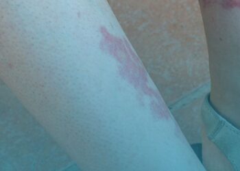 Tecnologia de implante auditivo para perda auditiva é tema de consulta pública da Comissão Nacional de Incorporação de Tecnologias no SUS