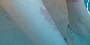 Tecnologia de implante auditivo para perda auditiva é tema de consulta pública da Comissão Nacional de Incorporação de Tecnologias no SUS