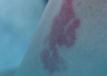 Tecnologia de implante auditivo para perda auditiva é tema de consulta pública da Comissão Nacional de Incorporação de Tecnologias no SUS