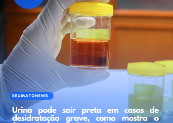 Urina pode sair preta em casos de desidratação grave, como mostra o filme “Sociedade da Neve”