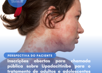 Dermatite Atópica: Upadacitinibe/Perspectiva do Paciente – Conitec