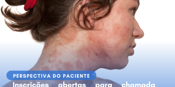 Dermatite Atópica: Upadacitinibe/Perspectiva do Paciente – Conitec