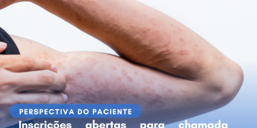 Dermatite Atópica: Abrocitinibe/Perspectiva do Paciente – Conitec