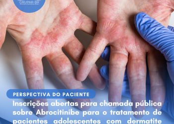 Dermatite Atópica: Abrocitinibe/Perspectiva do Paciente – Conitec