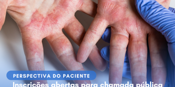 Dermatite Atópica: Abrocitinibe/Perspectiva do Paciente – Conitec