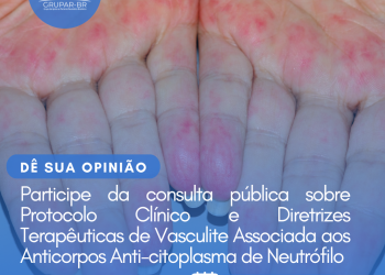 Protocolo Clínico e Diretrizes Terapêuticas: Vasculite Associada aos Anticorpos Anti-citoplasma de Neutrófilo/Consulta Pública – CONITEC