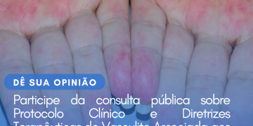 Protocolo Clínico e Diretrizes Terapêuticas: Vasculite Associada aos Anticorpos Anti-citoplasma de Neutrófilo/Consulta Pública – CONITEC