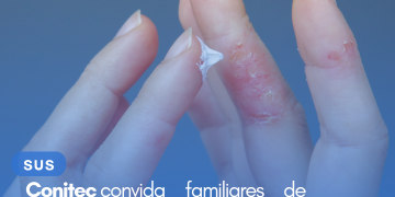 Conitec convida familiares de pacientes com dermatite atópica para contribuir com a perspectiva do paciente