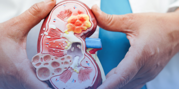 ANS debate sobre tratamento de pacientes adultos com nefrite lúpica ativa