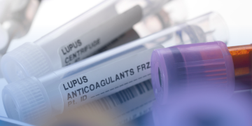 Lúpus: a importância da pesquisa clínica na busca de novos tratamentos para a doença