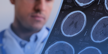 Esclerose Múltipla: mitos e verdades sobre a doença que atinge mais de 40 mil brasileiros