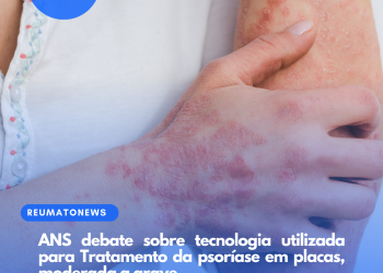 ANS debate sobre tecnologia utilizada para Tratamento da psoríase em placas, moderada a grave