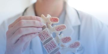 Campanha contra osteoporose chama atenção para a osteossarcopenia