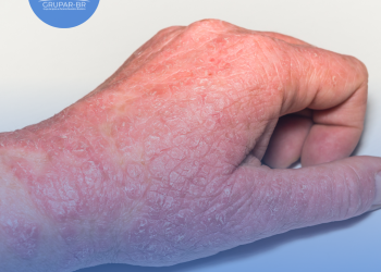 Dermatite Atópica: O Que Você Precisa Saber