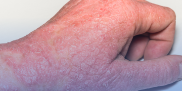 Dermatite Atópica: O Que Você Precisa Saber