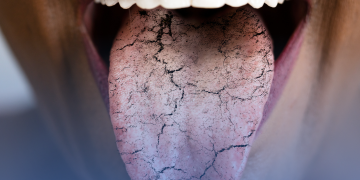 Doença de Sjögren é síndrome rara que também pode afetar os pulmões