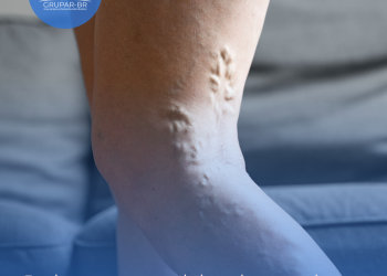 Trombose: mitos e verdades sobre uma doença silenciosa