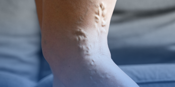 Trombose: mitos e verdades sobre uma doença silenciosa