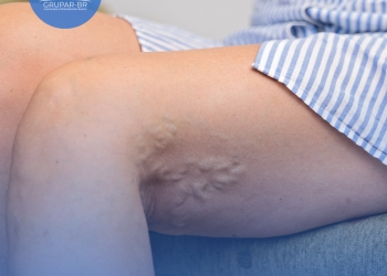 Risco de trombose aumenta após trauma ou cirurgia; entenda