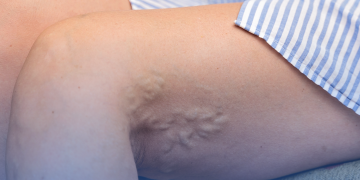 Risco de trombose aumenta após trauma ou cirurgia; entenda