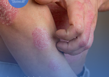 Dia Mundial da Psoríase: o que é, quais são os sintomas, tratamentos e prevenção