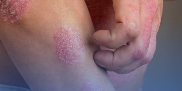 Dia Mundial da Psoríase: o que é, quais são os sintomas, tratamentos e prevenção