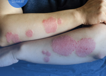 Psoríase: cientistas descobrem o que pode ser origem da doença crônica de pele; entenda