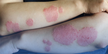 Psoríase: cientistas descobrem o que pode ser origem da doença crônica de pele; entenda