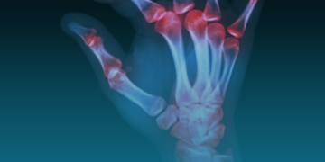 É possível prevenir artrite? Médico responde.