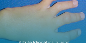 Artrite Idiopática Juvenil: entenda a doença que afeta crianças e adolescentes e os caminhos para o tratamento