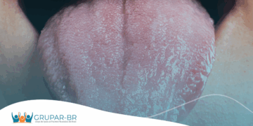 Confira o Biored Explica: Doença de Sjögren, enfermidade autoimune rara pode afetar também os pulmões