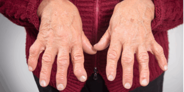 Artrite Psoriásica e a importância da abordagem multiprofissional