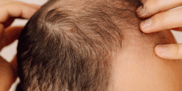 Novo medicamento oral contra queda de cabelo promete maior eficácia e menos riscos à saúde