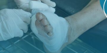 Consulta Pública nº 02/2026 – proposta de incorporação do transplante de membrana amniótica para o tratamento de pacientes com feridas crônicas e do pé diabético