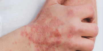 Renata Saldanha fala sobre viver com psoríase: ‘A gente luta contra o próprio corpo’