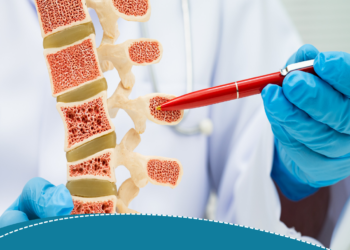 Cuidar dos ossos é cuidar da vida: como prevenir a osteoporose