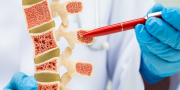 Cuidar dos ossos é cuidar da vida: como prevenir a osteoporose