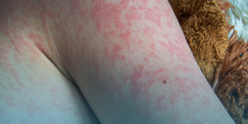 Rede global de virologistas alerta para ressurgimento do sarampo em meio ao pior surto da doença em 30 anos nos EUA