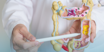 Câncer colorretal é a principal causa de morte por câncer em jovens nos EUA