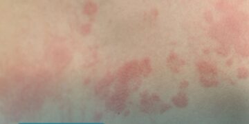 Cosaúde analisa contribuições e debate propostas de incorporação de novas tecnologias para o tratamento da dermatite atópica, fibrilação atrial e câncer de próstata