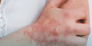 Hanseníase: Brasil registrou mais de 300 mil casos da doença em dez anos