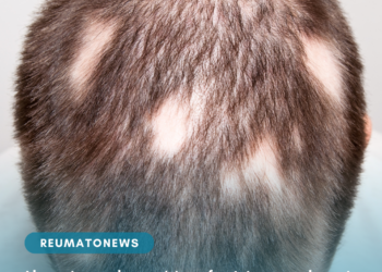 Alopecia androgenética feminina e alopecia areata: diagnóstico correto é fundamental para tratamento adequado da queda de cabelo