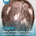 Alopecia androgenética feminina e alopecia areata: diagnóstico correto é fundamental para tratamento adequado da queda de cabelo