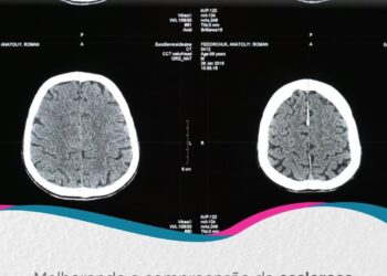 EULAR 2026: Melhorando a compreensão da esclerose sistêmica
