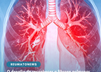 O desafio de reconhecer a fibrose pulmonar, doença rara e crônica, antes que ela evolua