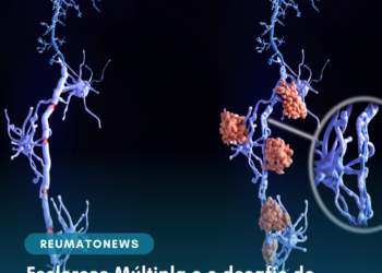 Esclerose Múltipla e o desafio do diagnóstico precoce